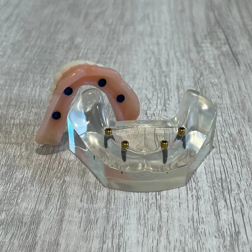 snap-in implant dentures