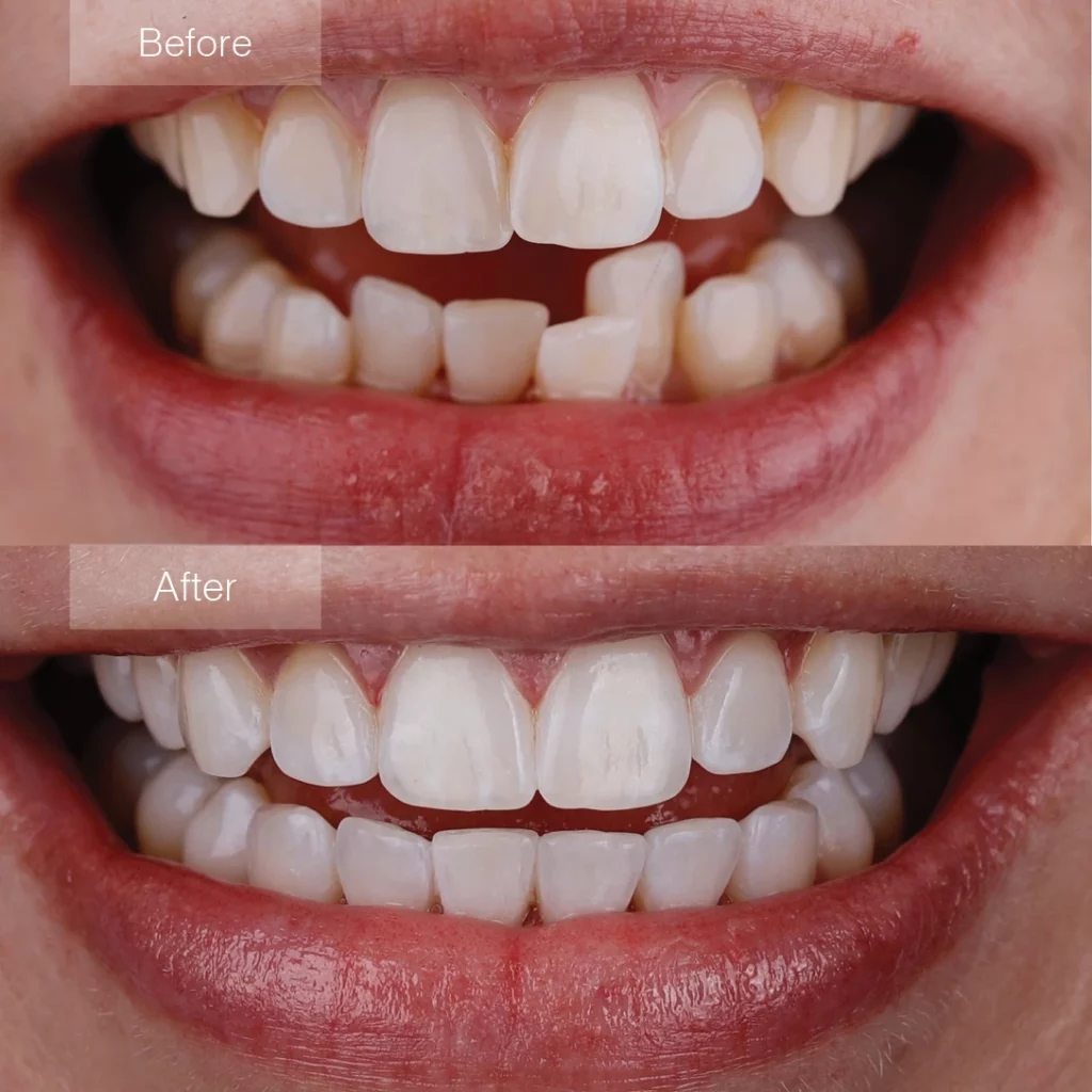 invisalign before and after