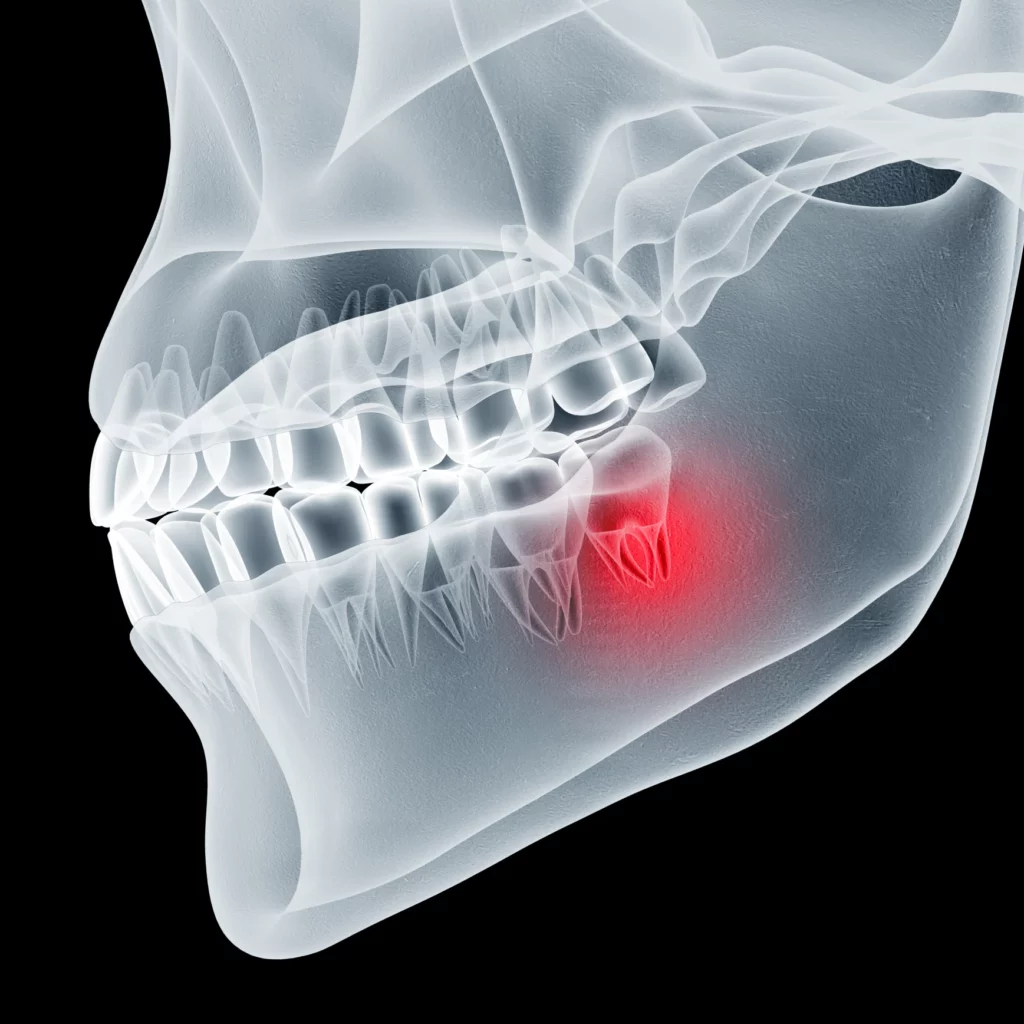 wisdom teeth removal in Brentwood, TN