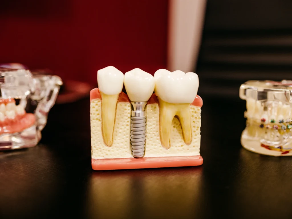 model of a single tooth dental implant | cost of dental implants in Brentwood, TN