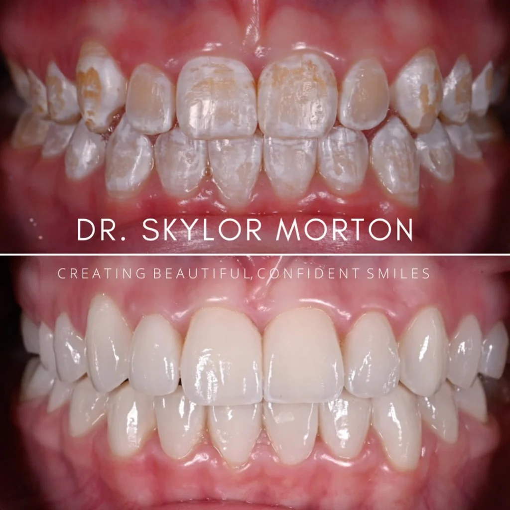 Before and after a smile makeover in Tennessee at Jolly & Morton Advanced Dentistry by Dr. Skylor Morton