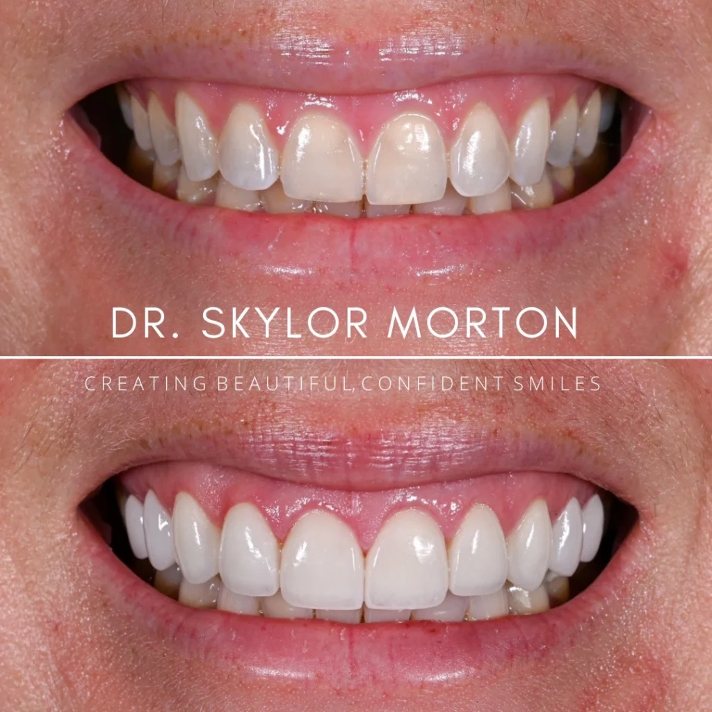 Before and after a smile makeover in Tennessee at Jolly & Morton Advanced Dentistry by Dr. Skylor Morton