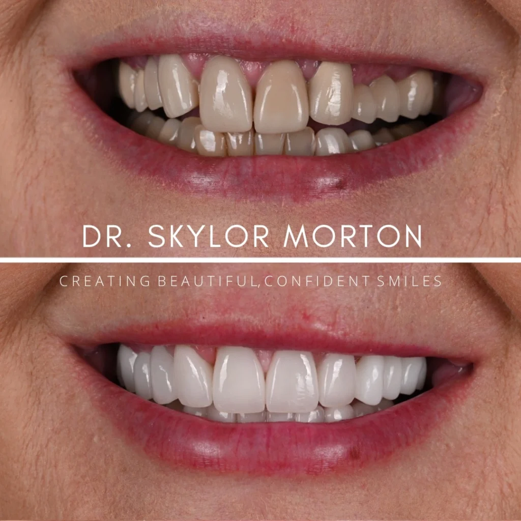 Before and after a smile makeover in Tennessee at Jolly & Morton Advanced Dentistry by Dr. Skylor Morton