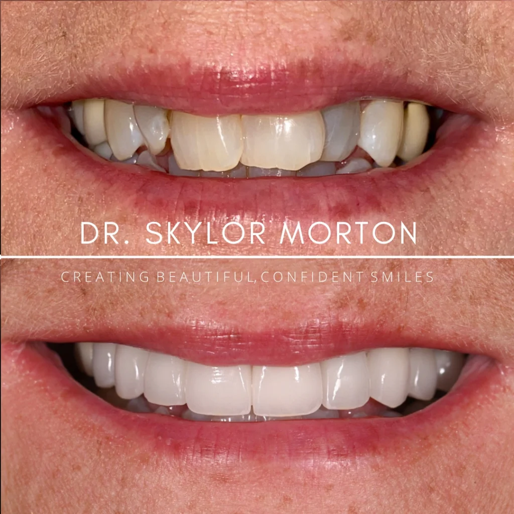 Before and after a smile makeover in Tennessee at Jolly & Morton Advanced Dentistry by Dr. Skylor Morton