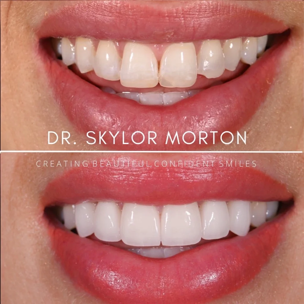 Before and after a smile makeover in Tennessee at Jolly & Morton Advanced Dentistry by Dr. Skylor Morton