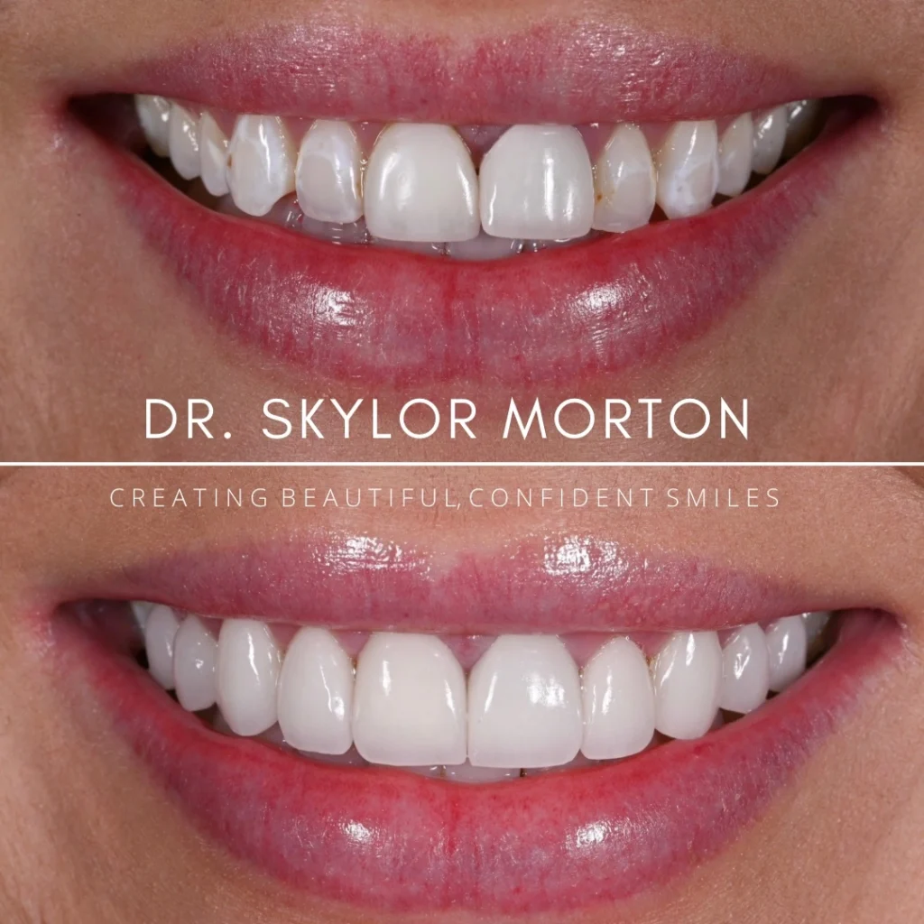 Before and after a smile makeover in Tennessee at Jolly & Morton Advanced Dentistry by Dr. Skylor Morton