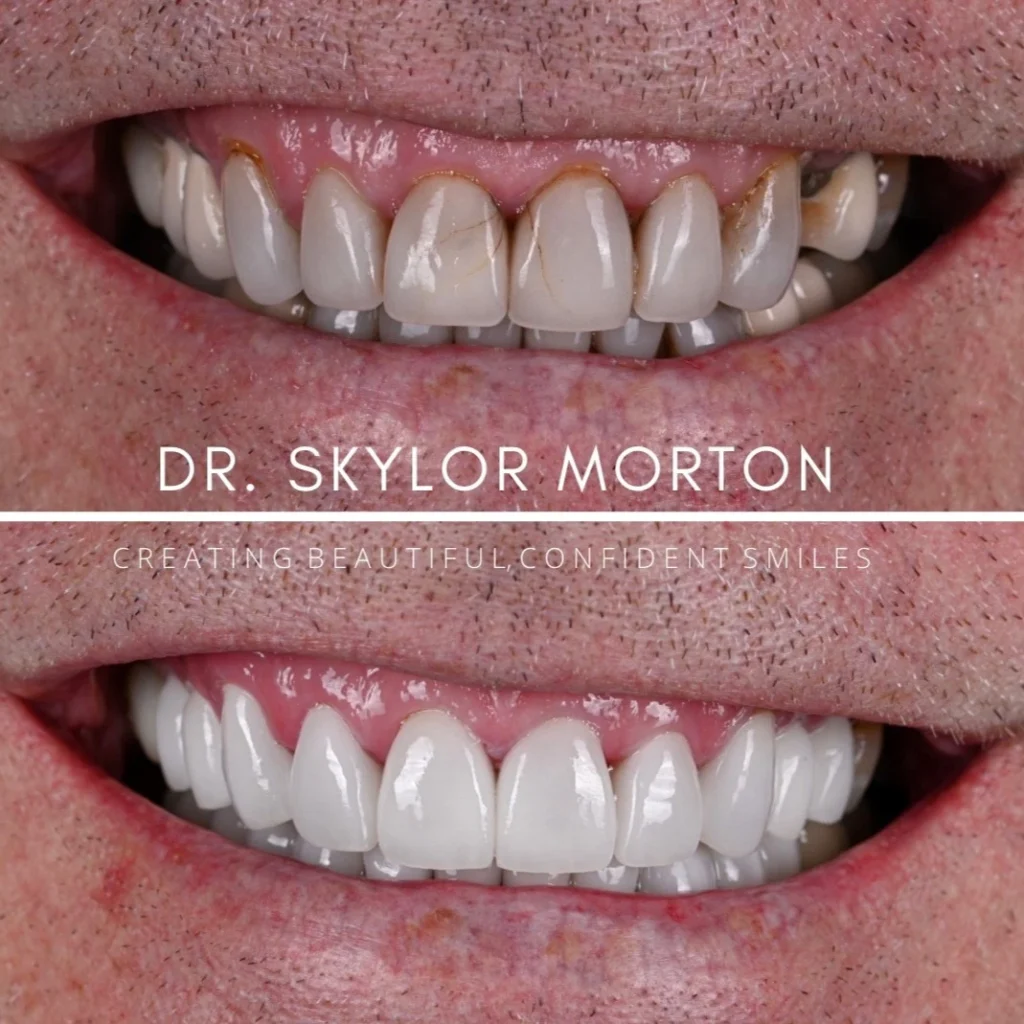 Before and after a smile makeover in Tennessee at Jolly & Morton Advanced Dentistry by Dr. Skylor Morton