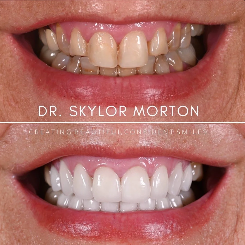 Before and after a smile makeover in Tennessee at Jolly & Morton Advanced Dentistry by Dr. Skylor Morton