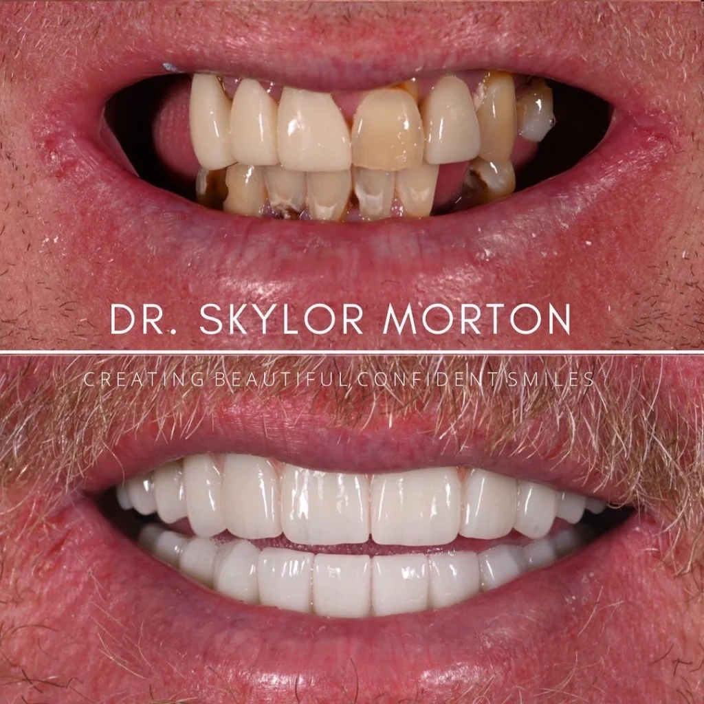 Before and after a smile makeover in Tennessee at Jolly & Morton Advanced Dentistry by Dr. Skylor Morton