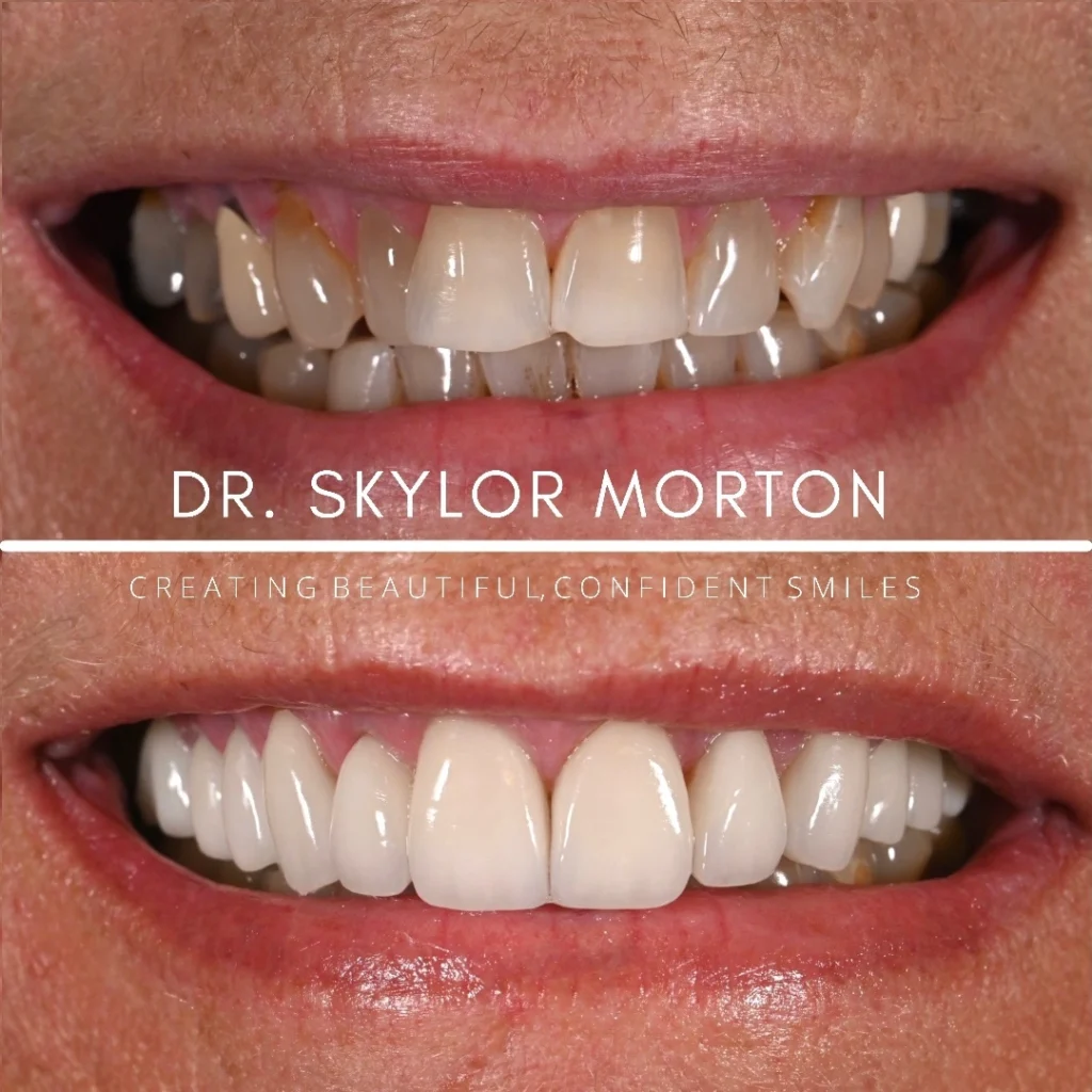 Before and after a smile makeover in Tennessee at Jolly & Morton Advanced Dentistry by Dr. Skylor Morton