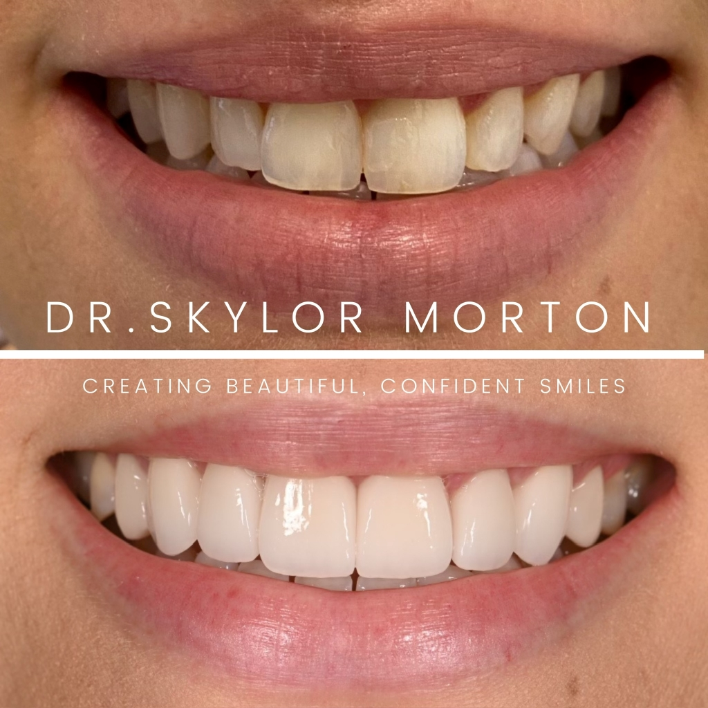 Before and after a smile makeover in Tennessee at Jolly & Morton Advanced Dentistry by Dr. Skylor Morton