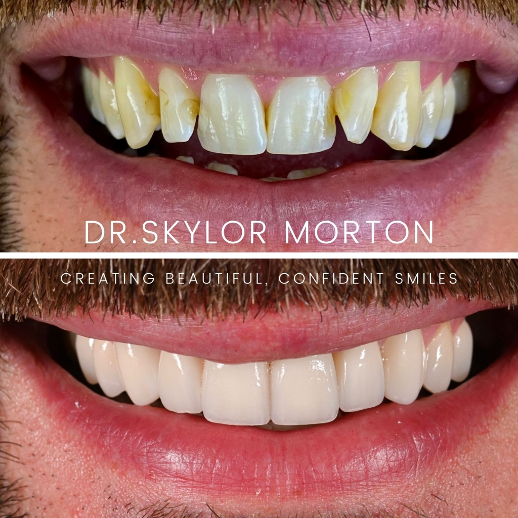 Before and after a smile makeover in Tennessee at Jolly & Morton Advanced Dentistry by Dr. Skylor Morton