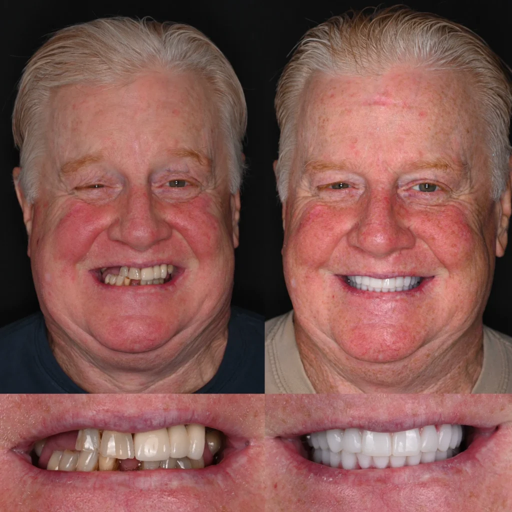 Before and after dental implants in Brentwood, TN at Jolly & Morton Advanced Dentistry