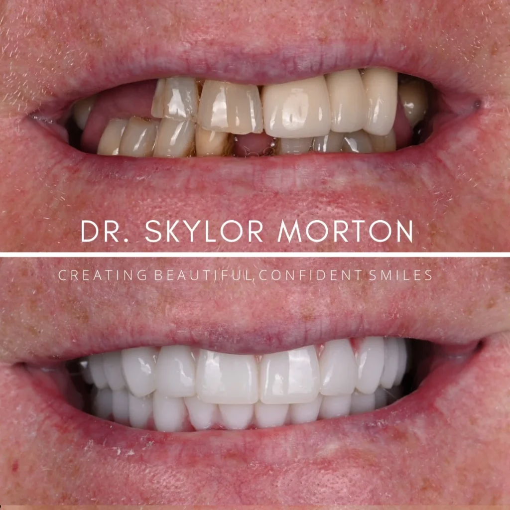 Before and after dental implants in Brentwood, TN at Jolly & Morton Advanced Dentistry