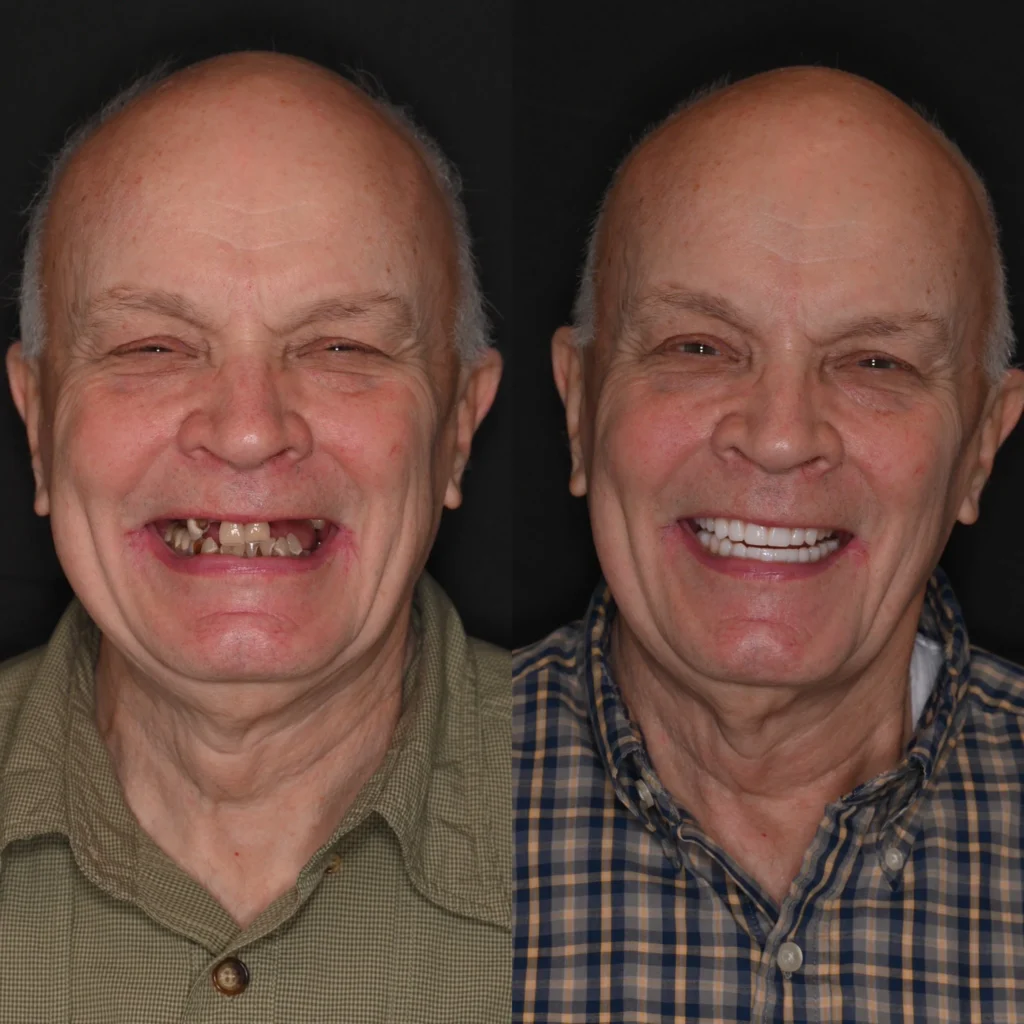 Before and after dental implants in Brentwood, TN at Jolly & Morton Advanced Dentistry