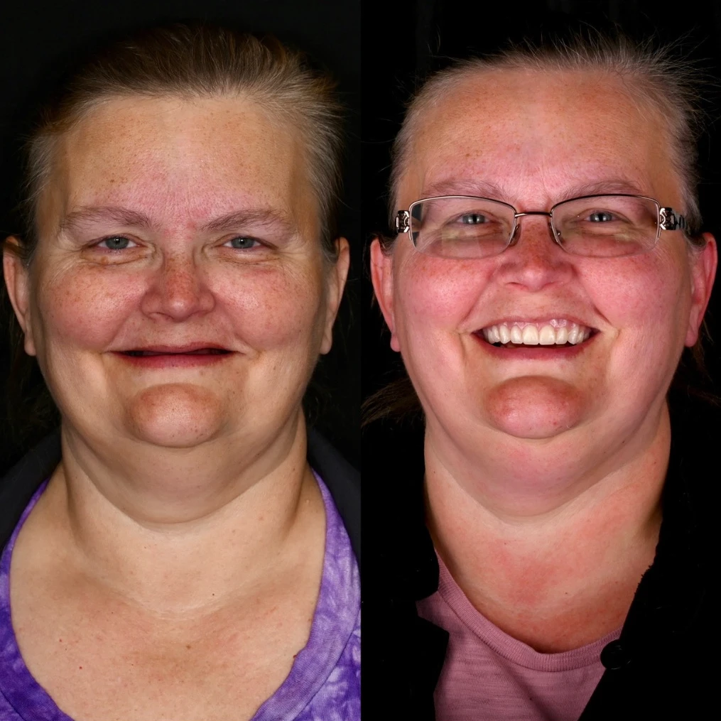 Before and after dental implants in Brentwood, TN at Jolly & Morton Advanced Dentistry