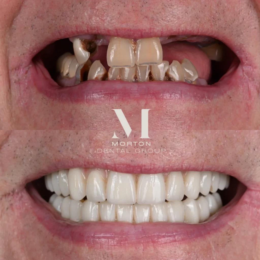 Before and after dental implants in Brentwood, TN at Jolly & Morton Advanced Dentistry