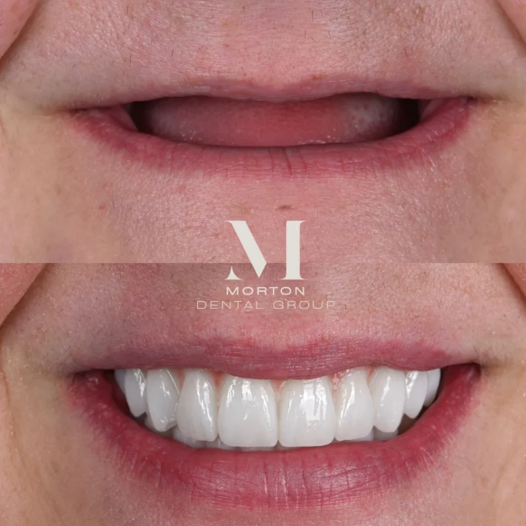 Before and after dental implants in Brentwood, TN at Jolly & Morton Advanced Dentistry