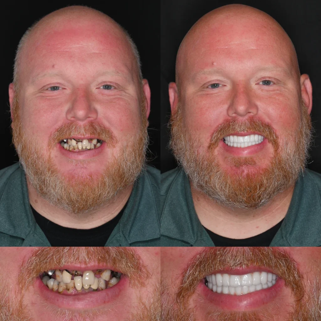 Before and after dental implants in Brentwood, TN at Jolly & Morton Advanced Dentistry