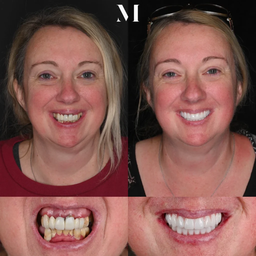 Before and after dental implants in Brentwood, TN at Jolly & Morton Advanced Dentistry